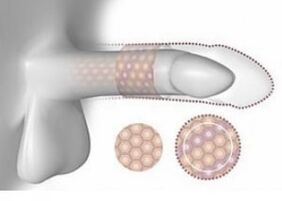 Palielināts dzimumloceklis tilpumā